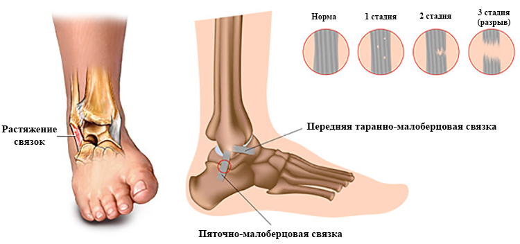 Виды разрыва