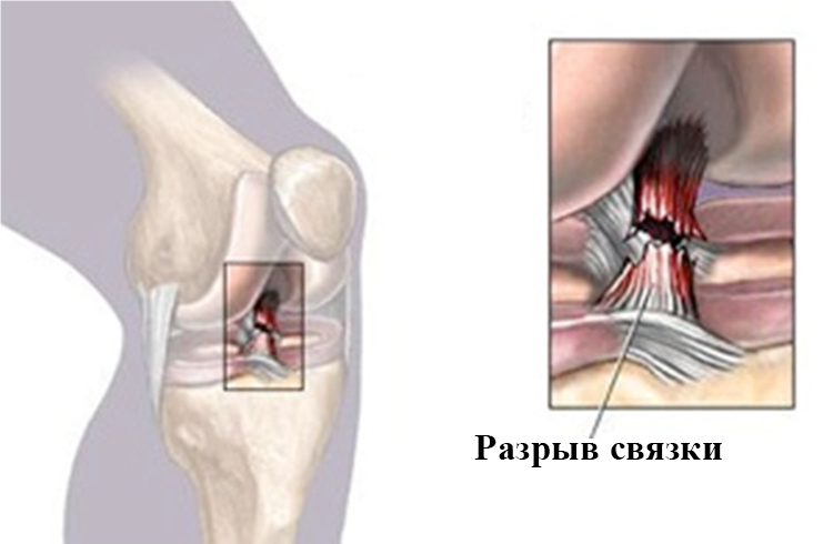 Разрыв связки