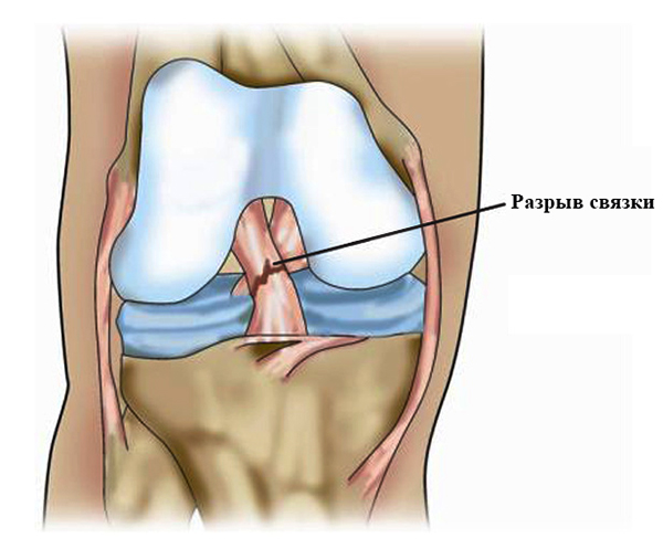 Разрыв связки