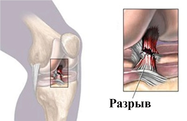 Как выглядит разрыв