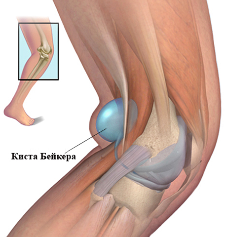 Киста Бейкера
