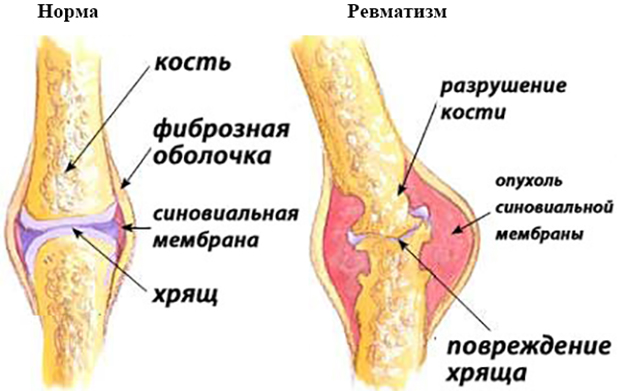 Норма и ревматизм