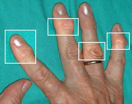 Симптомы артроза пальцев