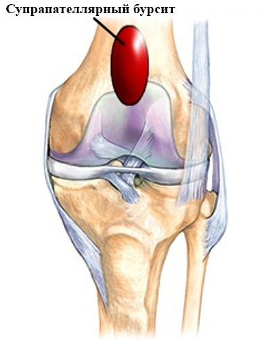 Супрапателлярный бурсит