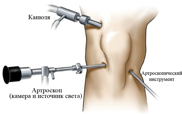 Артроскопия