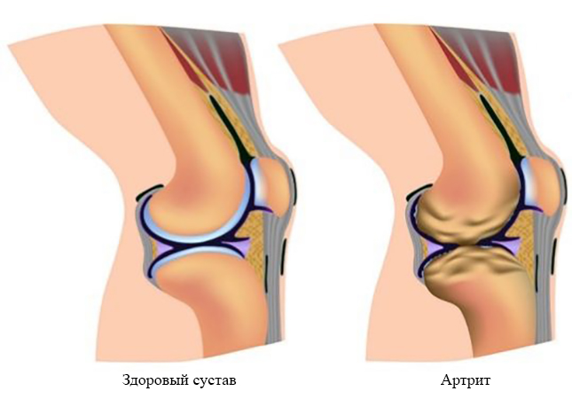 Здоровый сустав и артрит