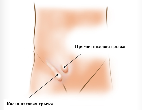 Виды паховых грыж