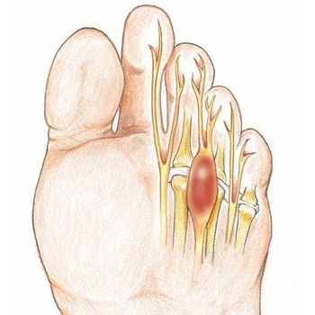 nevroma-mortona1.jpg