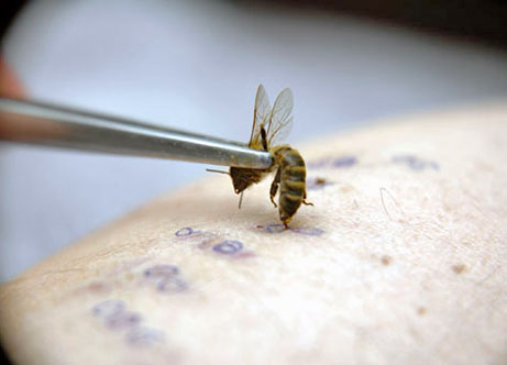 Лечение укусами пчел, точки ужаливания