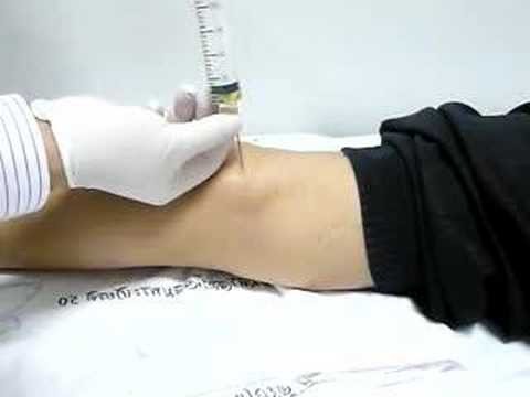 cyst Becker knee joint treatment