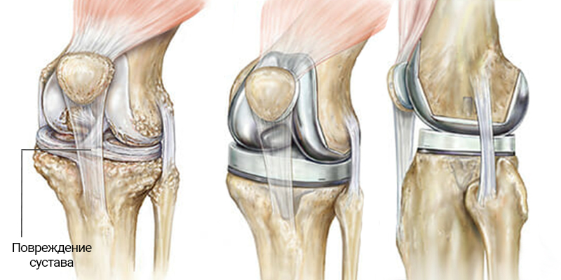 Операции на коленном суставе стоимость. Артроз коленного сустава эндопротез. Артропластика коленного сустава. Деформирующий остеоартроз коленного сустава эндопротез. Эндопротез коленного сустава.