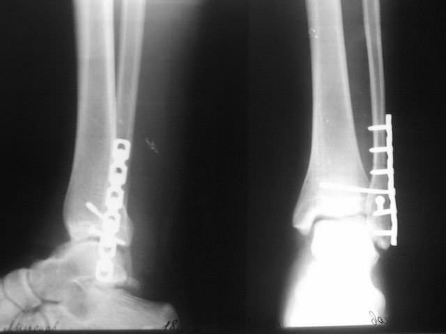 Рентген перелома щиколки со смещением