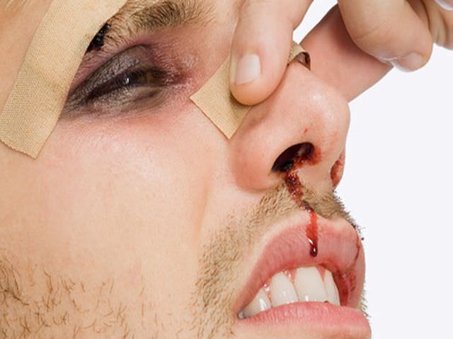 последствия после перелома носовой перегородки