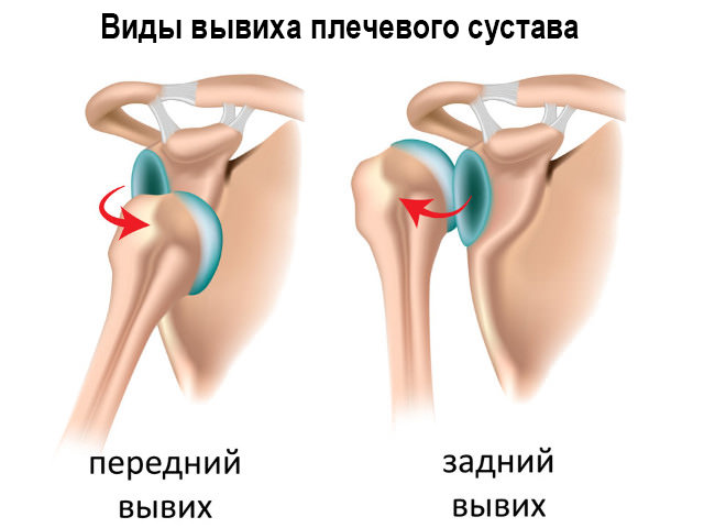Схема травмы плеча 
