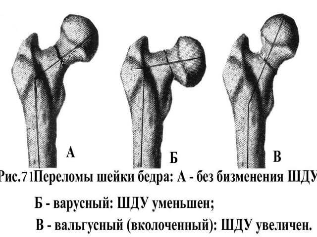 Разновидность перелома шейки бедренной кости