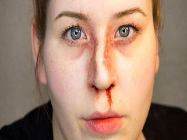 как восстановить нос после перелома