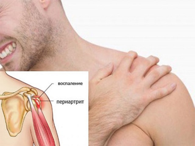 Воспаление в плече