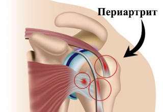 Что такое периартроз плечевого сустава и как его лечить