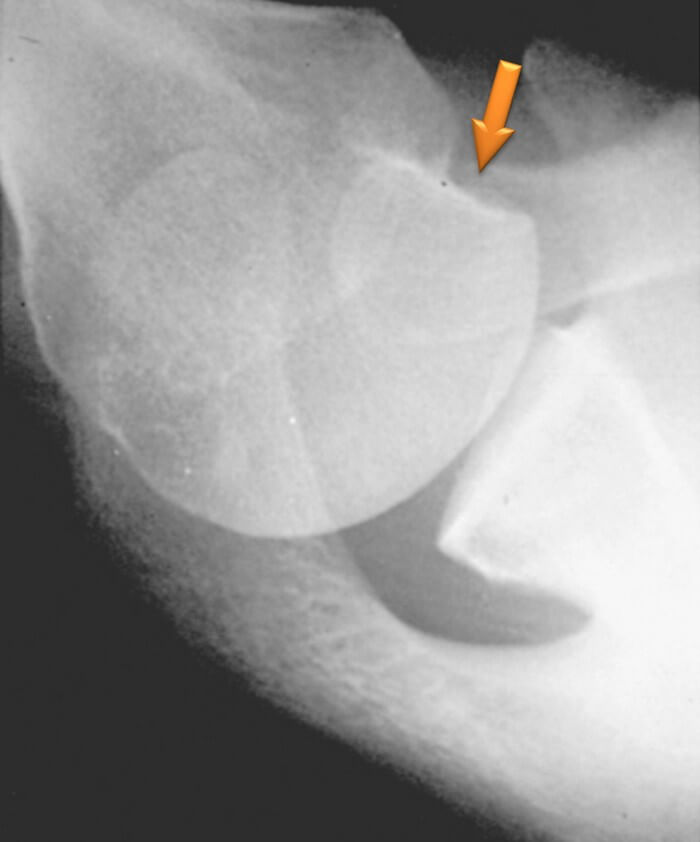 Импрессионный перелом. Импрессионный перелом головки плечевой кости. Импрессионный перелом плечевого сустава. Подвывих плечевой кости. Импрессионный перелом головки Банкарта.