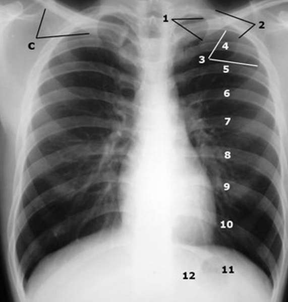 Лечение проблем с позвоночником - рентген грудной клетки