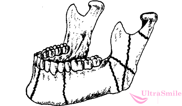 перелом нижней челюсти виды