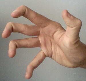 Гипермобильные пальцы и thumb.jpg