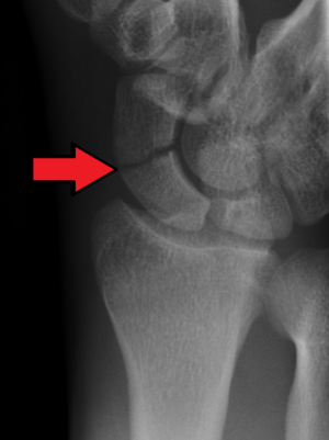 X-ray of scaphoid fracture.png