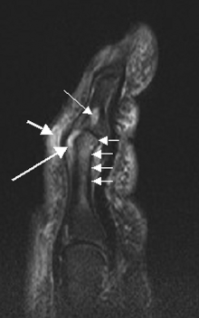 Psoriatic arthritis digit ar1934-2.gif