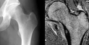 Osteoidosteom Roentgen-MRT.png