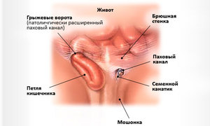 Лечение паховой грыжи у мужчин