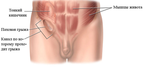 Симптомы паховой грыжи у мужчин