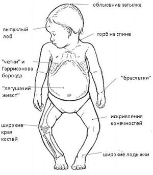 Методы лечения рахита