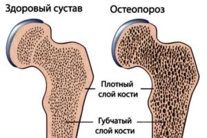 рисунок нормальная и хрупкая костная ткань