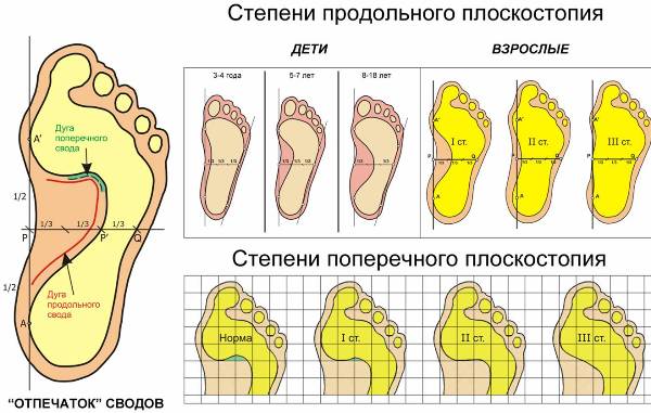 Степени плоскостопия у детей