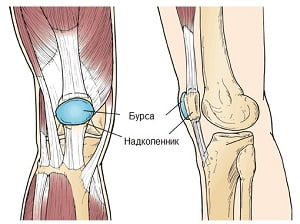 препателлярный бурсит коленного сустава лечение