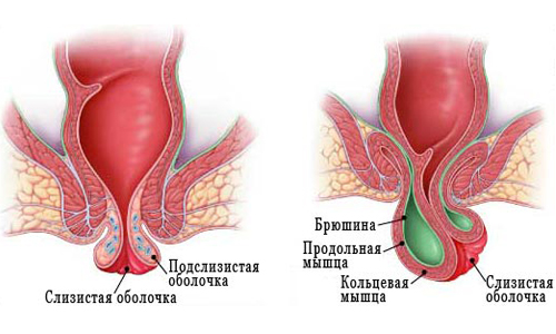 Схематичное изображение грыжи кишечника