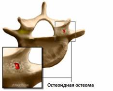 Опухоли позвоночника