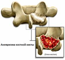 Опухоли позвоночника