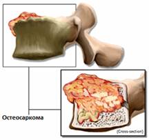 Опухоли позвоночника