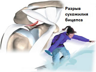 Разрывы сухожилий бицепса плеча