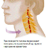 Синдром вертебральной (позвоночной) артерии