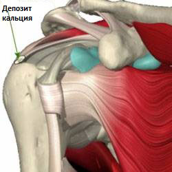 Кальцинирующий тендинит плеча