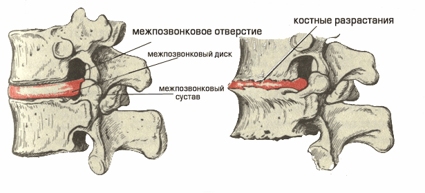 Межпозвонковые диски