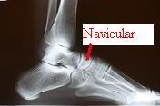 navicular stress fracture treatment prevention