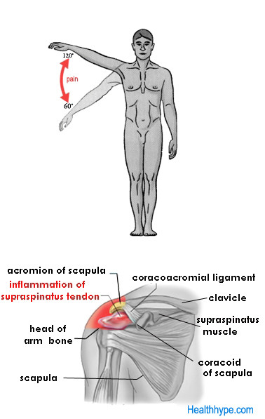 Supraspinatus tendinitis causing painful arc syndrome