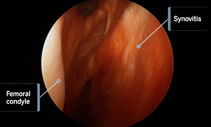 Image: arthroscopic camera view of the synovitis in the inside of the knee joint.