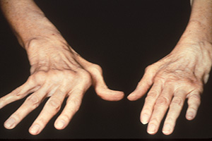rheumatoid arthritis in the hands