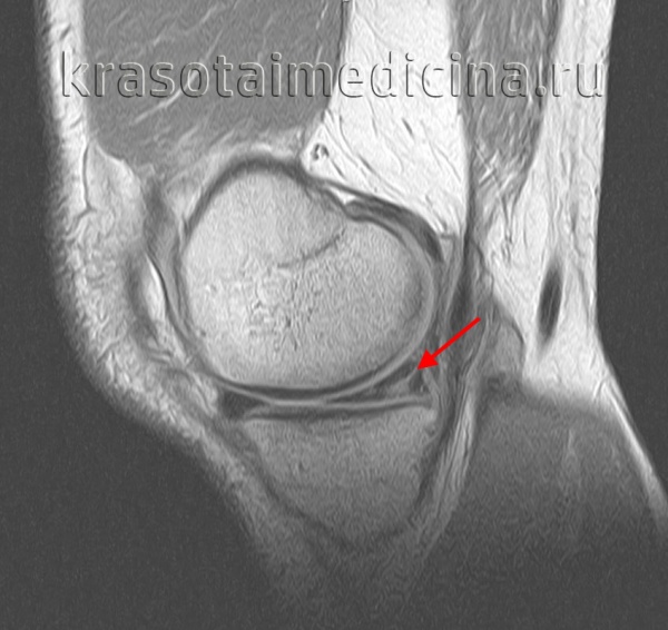 МРТ коленного сустава. Разрыв заднего рога медиального мениска.