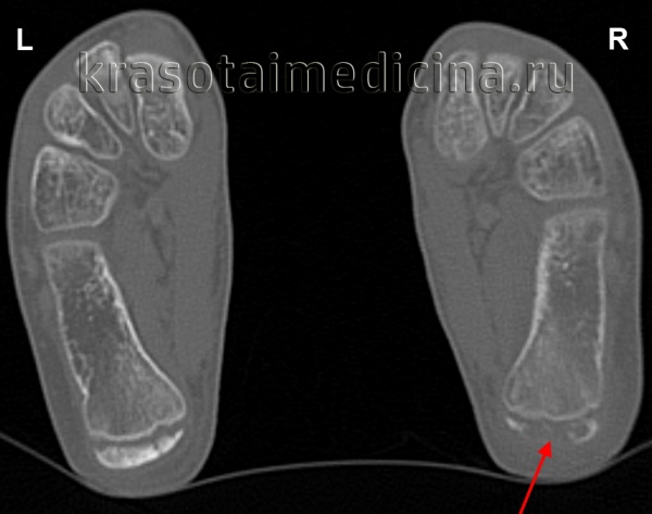 КТ стоп. Справа определяется нарушение структуры ядра окостенения бугра пяточной кости (болезнь Шинца) в виде выраженного асимметричного разрежения костной ткани. Слева – норма