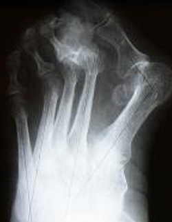 Молоткообразный II палец стопы. Hallux Valgus. Рентгенограмма